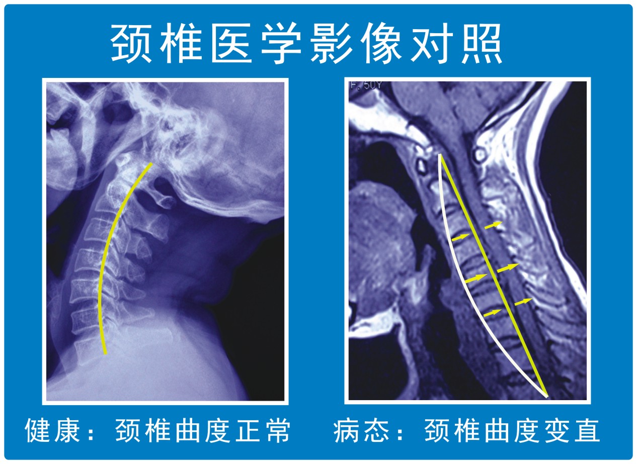 颈椎曲度改变医学影像对照