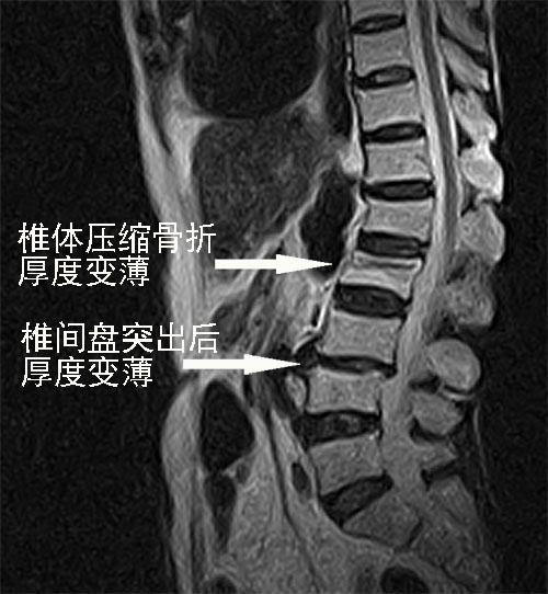 隆回长岭中医医院,隆回颈椎病,隆回腰椎病,隆回关节病,隆回风湿病,隆回股骨头坏死